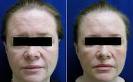 Xeomin Before and After