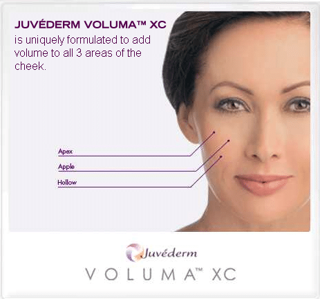 Juvederm