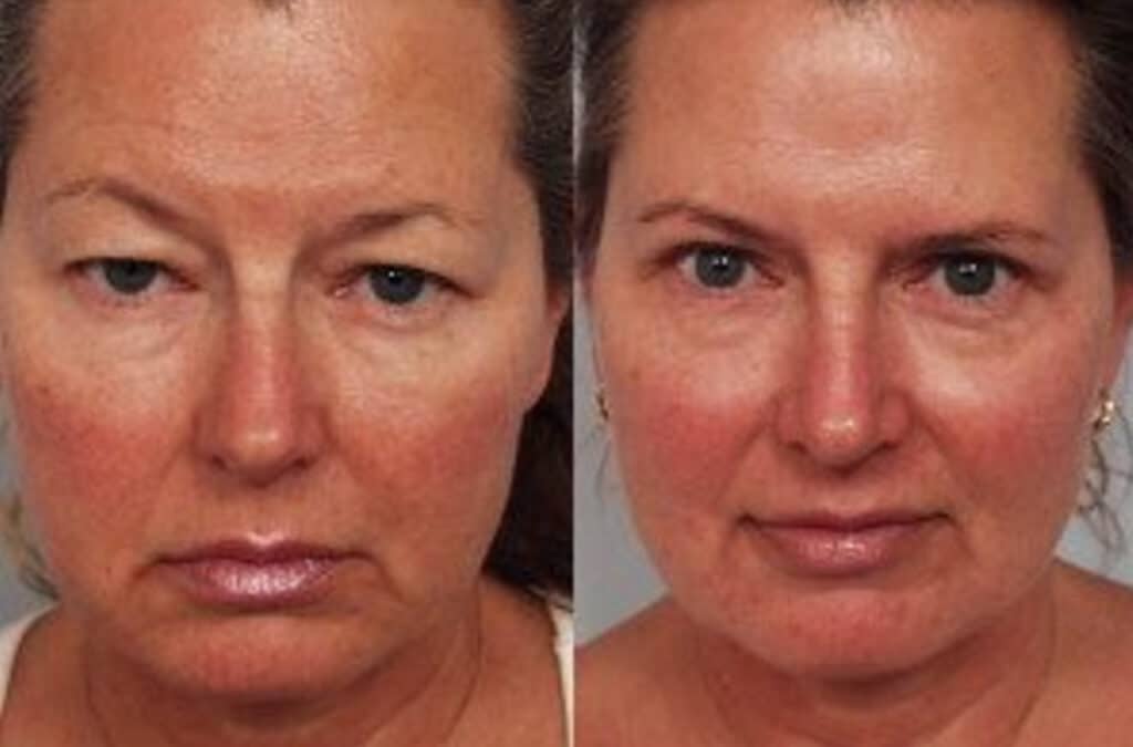 blepharoplasty before and after photo 3