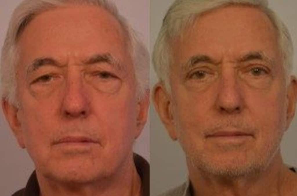 blepharoplasty before and after photo 2